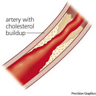 atherosclerosis atherosclerosis