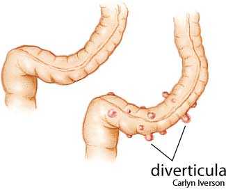diverticulosis diverticulosis