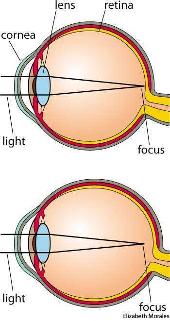 myopia myopia