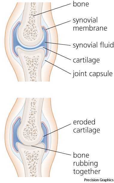 osteoarthritis osteoarthritis